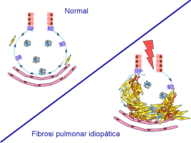 Efectes de la fibrosi pulmonar idiopàtica